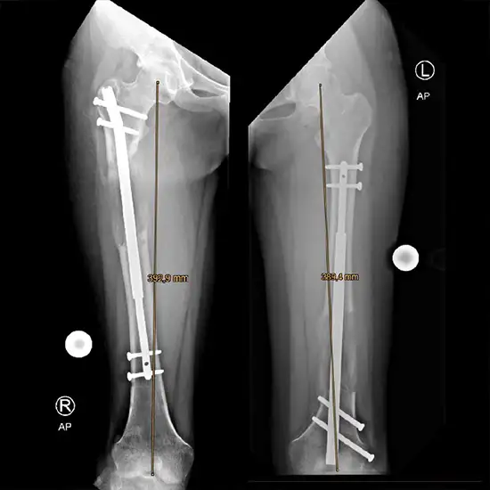 x-ray bilateral femur ap view